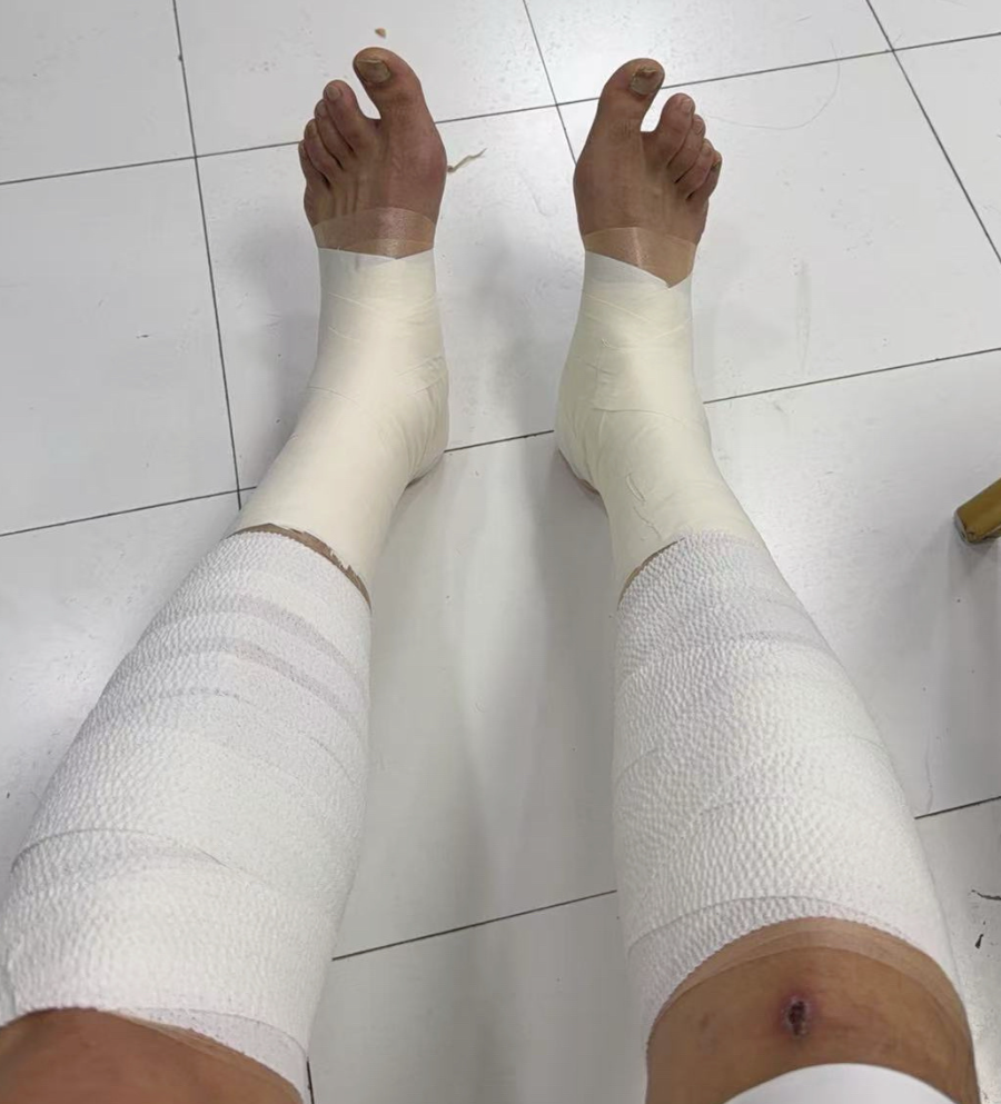 体育直播播放-胜山西谁注意翟晓川赛后伤势？双腿拉伤绑满绷带，看着都残忍！